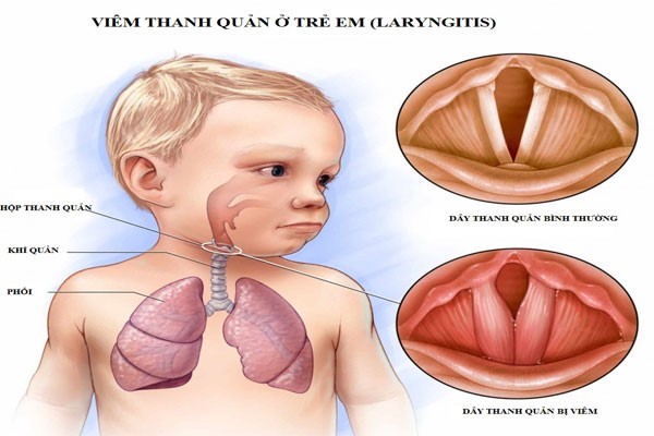 Viêm thanh quản ở trẻ em.