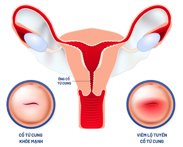 Viêm lộ tuyến tử cung