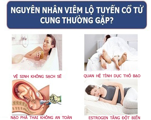 Các nguyên nhân gây viêm lộ tuyến tử cung