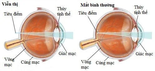 Hình ảnh so sánh giữa mắt bình thường và mắt viễn thị