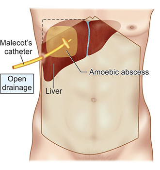 Dẫn lưu áp xe gan giúp giảm bớt áp lực trong gan