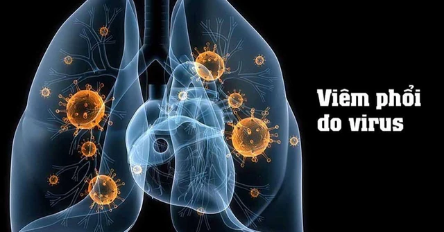 Viêm phổi do virus