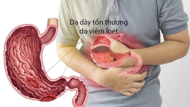 Viêm loét dạ dày