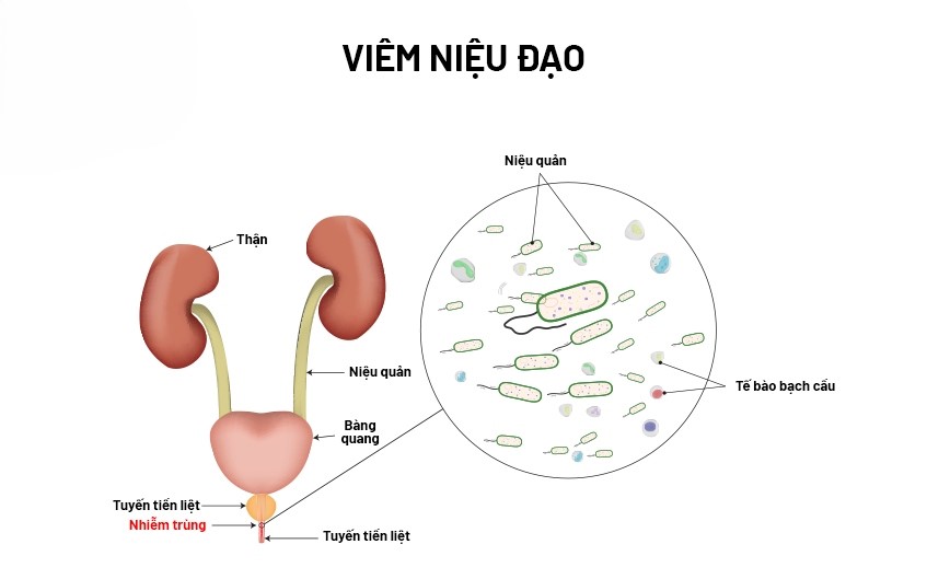 Viêm niệu đạo ở nam giới