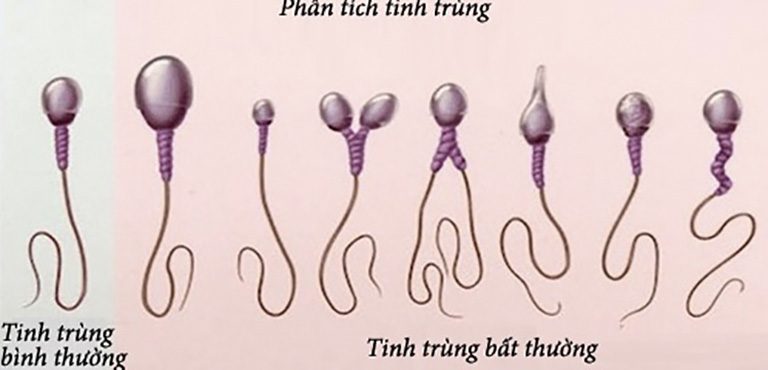 Tinh trùng bất thường là nguyên nhân gây vô sinh ở nam 