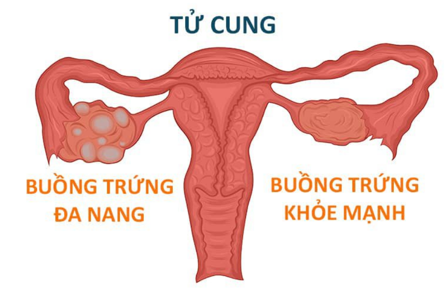 Buồng trứng đa nang là 1 trong những nguyên nhân gây vô sinh ở nữ giới