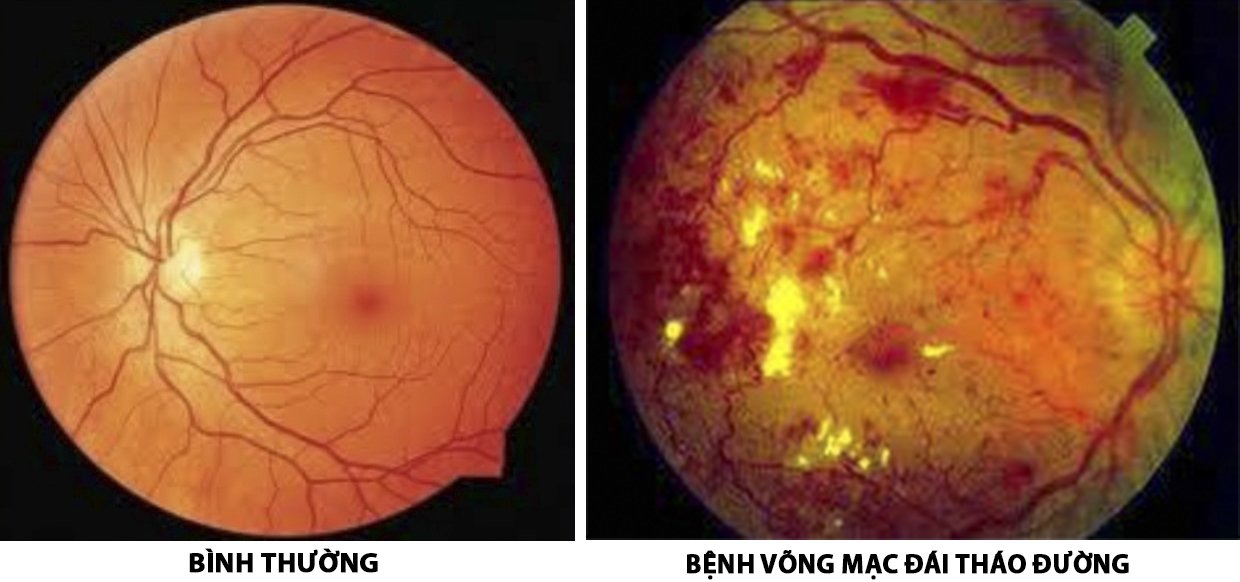 Phòng ngừa bệnh võng mạc do tiểu đường ở người cao tuổi