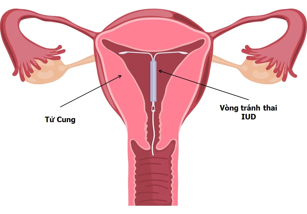 Vòng tránh thai