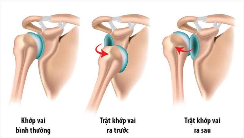 Hình ảnh minh họa cấu trúc khớp vai và tình trạng trật khớp khi chỏm xương cánh tay lệch khỏi ổ chảo, gây đau và mất khả năng vận động
