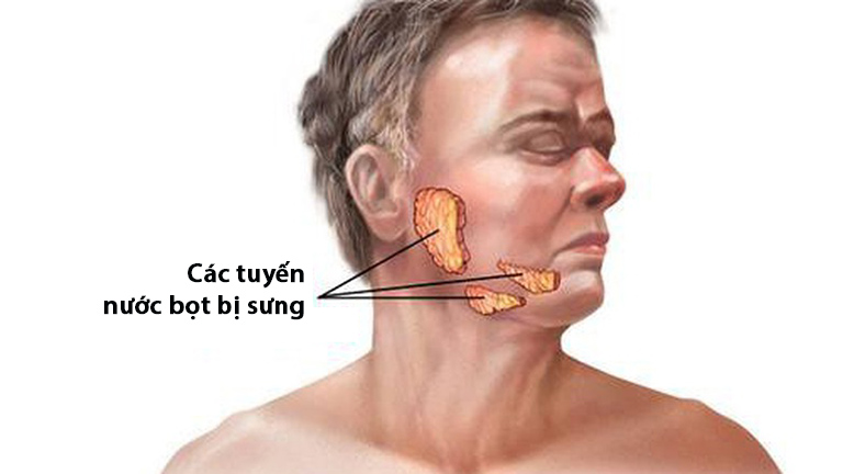 Đau và sưng là triệu chứng viêm tuyến nước bọt là