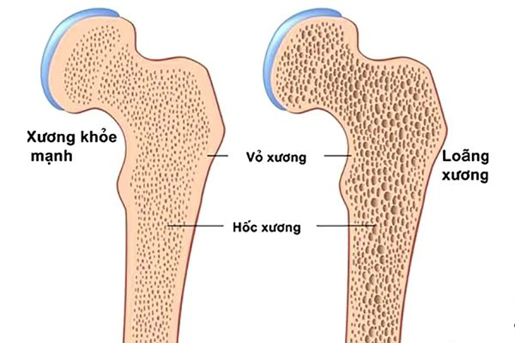 Thiếu vitamin D gây bệnh loãng xương