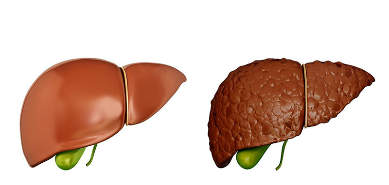 Bệnh nhân xơ gan có nguy cơ bị vú to ở nam giới