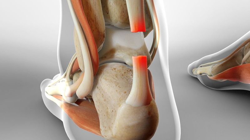 Chấn thương thể thao là nguyên nhân phổ biến gây đứt gân Achilles