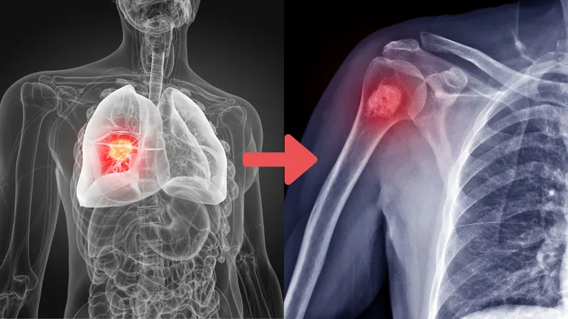 Hình ảnh minh họa thuốc chứa hoạt chất Denosumab hỗ trợ tăng mật độ khoáng của xương 