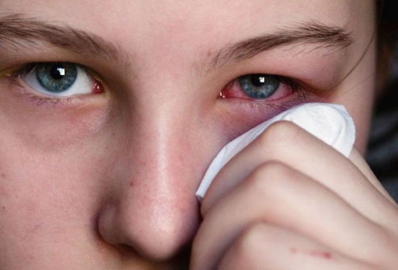 Mắt đỏ và cộm xốn là những biểu hiện đặc trưng của bệnh 