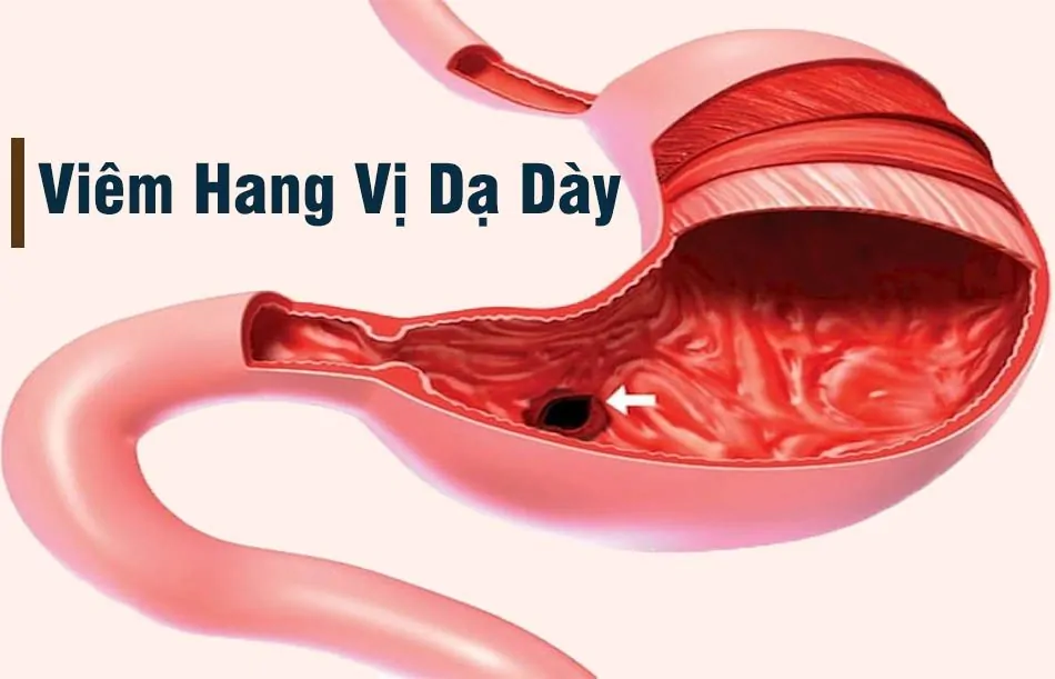 Viêm hang vị dạ dày