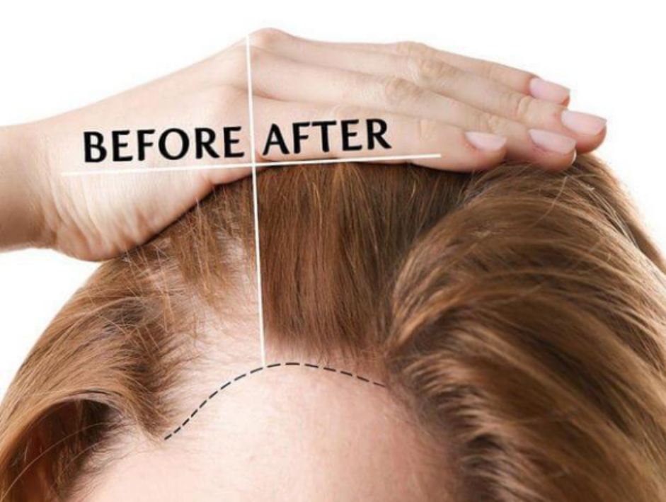 Cấy tóc điều trị hói