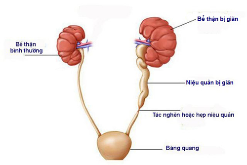 Sỏi niệu quản gây tổn thương sức khỏe nếu không chữa trị kịp thời.