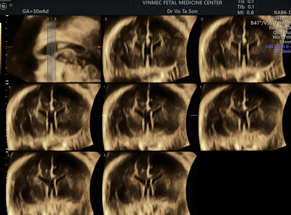 Phương pháp chẩn đoán loạn sản vách thị giác là chụp MRI
