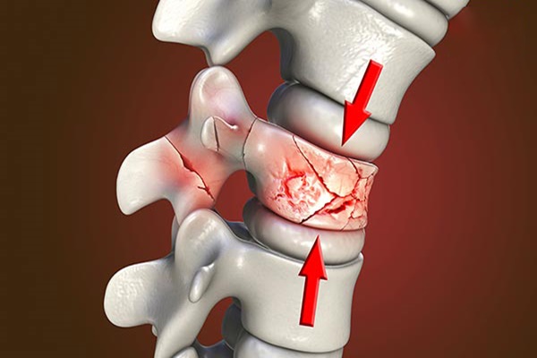 Chẩn đoán xẹp đốt sống