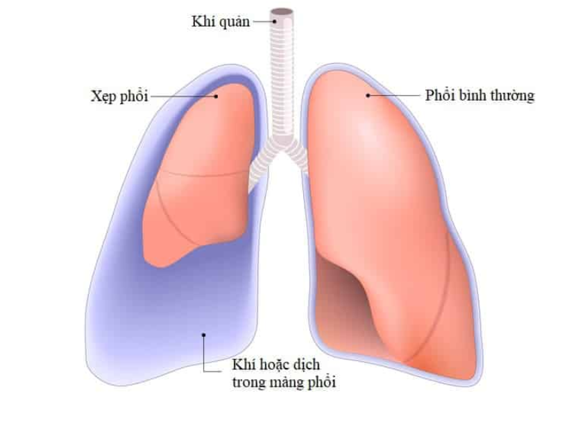 Phân loại xẹp phổi