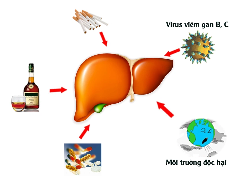 Những lưu ý quan trọng trong quá trình điều trị xơ gan