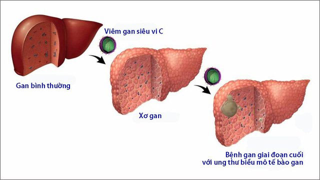 Viêm gan B và viêm gan C là nguyên nhân chính gây xơ gan