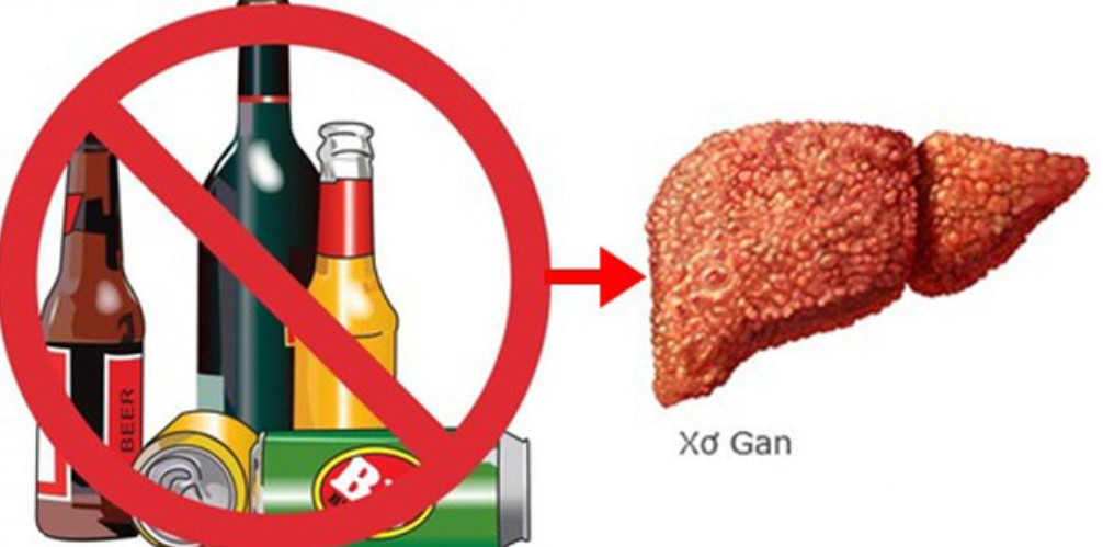 Nguyên nhân dẫn đến xơ gan là do bia rượu