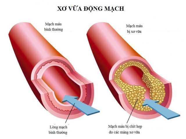https://prod-cdn.pharmacity.io/blog/xo-vua-dong-mach-1.jpg?X-Amz-Algorithm=AWS4-HMAC-SHA256&X-Amz-Content-Sha256=UNSIGNED-PAYLOAD&X-Amz-Credential=AKIAUYXZVMJMURHIYJSN%2F20240621%2Fap-southeast-1%2Fs3%2Faws4_request&X-Amz-Date=20240621T081422Z&X-Amz-Expires=600&X-Amz-Signature=8d41d5ee1e52e7eb0172b72a2bcc730262e1fa4e6668529e0dfd484f230dab5e&X-Amz-SignedHeaders=host