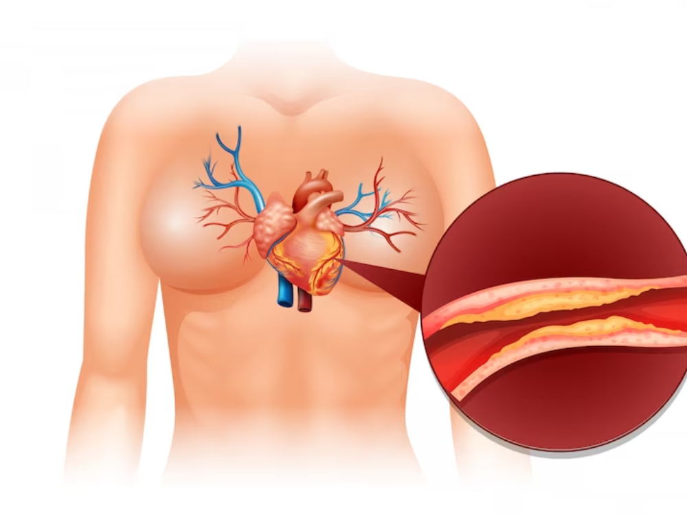 Xơ vữa động mạch là một trong những nguyên nhân gây bệnh tim thiếu máu cục bộ