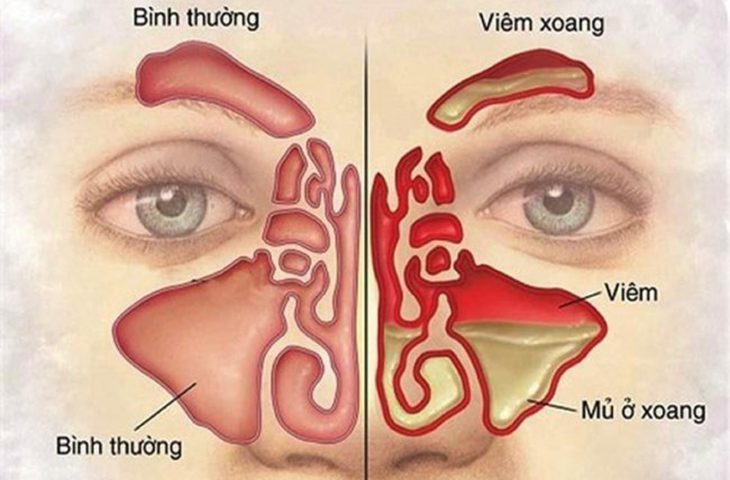 Viêm xoang trán có thể do polyp mũi chứa đầy dịch nhầy, mủ ở xoang