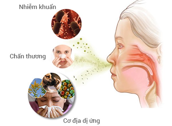 Có nhiều nguyên nhân từ môi trường gây ra viêm xoang trán