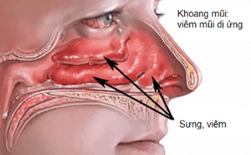 Hình ảnh khoang mũi sưng viêm do dị ứng