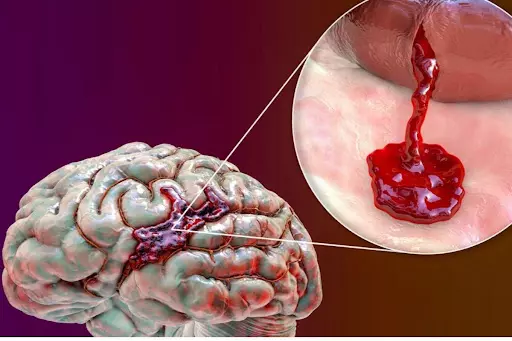 Xuất huyết não là tình trạng mạch máu não bị đứt hoặc vỡ