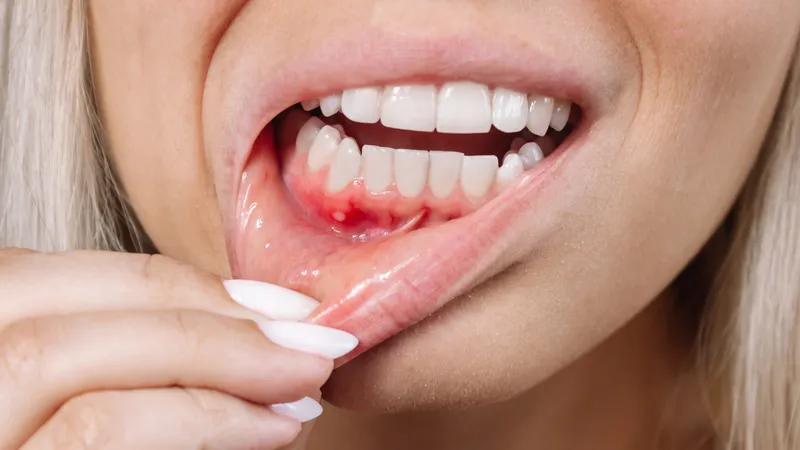 Súc miệng bằng nước muối sinh lý có thể giúp làm sạch khoang miệng và hỗ trợ giảm kích ứng niêm mạc