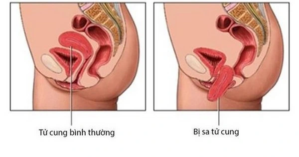 Sa tử cung khi mang thai