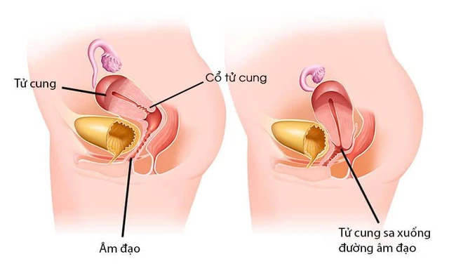  Sa tử cung là tình trạng tử cung di chuyển ra khỏi vị trí bình thường và tụt vào trong âm đạo