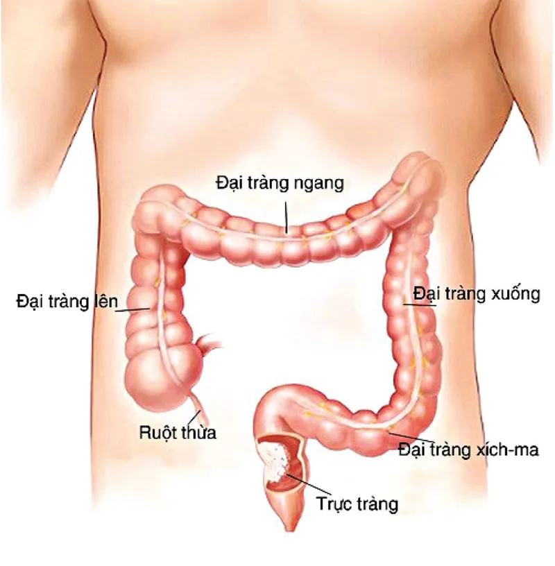 Các bệnh lý phổ biến có thể xảy ra ở trực tràng