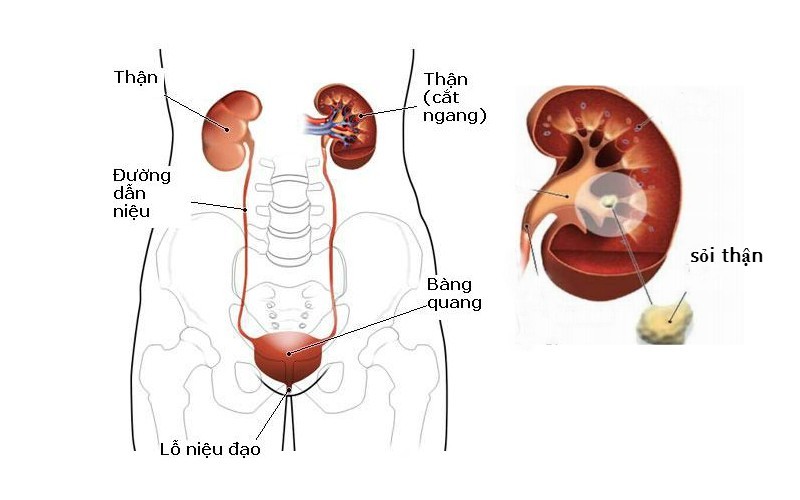 Sỏi thận là bệnh lý thường gặp nhất của đường tiết niệu