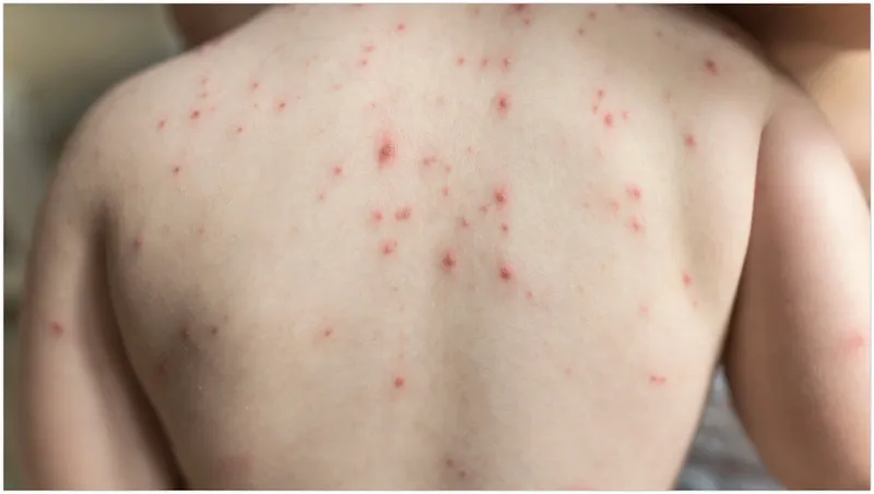 Tìm hiểu về da nổi những hạt nhỏ không ngứa