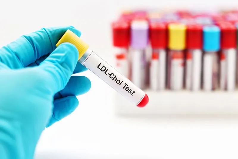 Mảng xơ vữa hình thành khi LDL cholesterol tích tụ lâu ngày trong động mạch