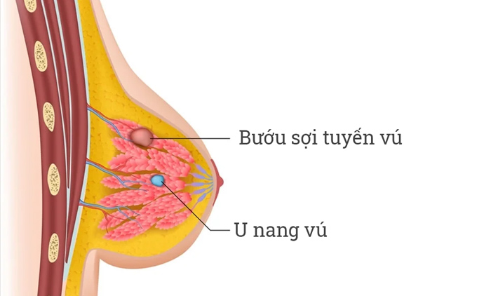 Bướu sợi tuyến vú BI-RADS 3: Nguyên nhân, Triệu chứng và Cách Điều Trị