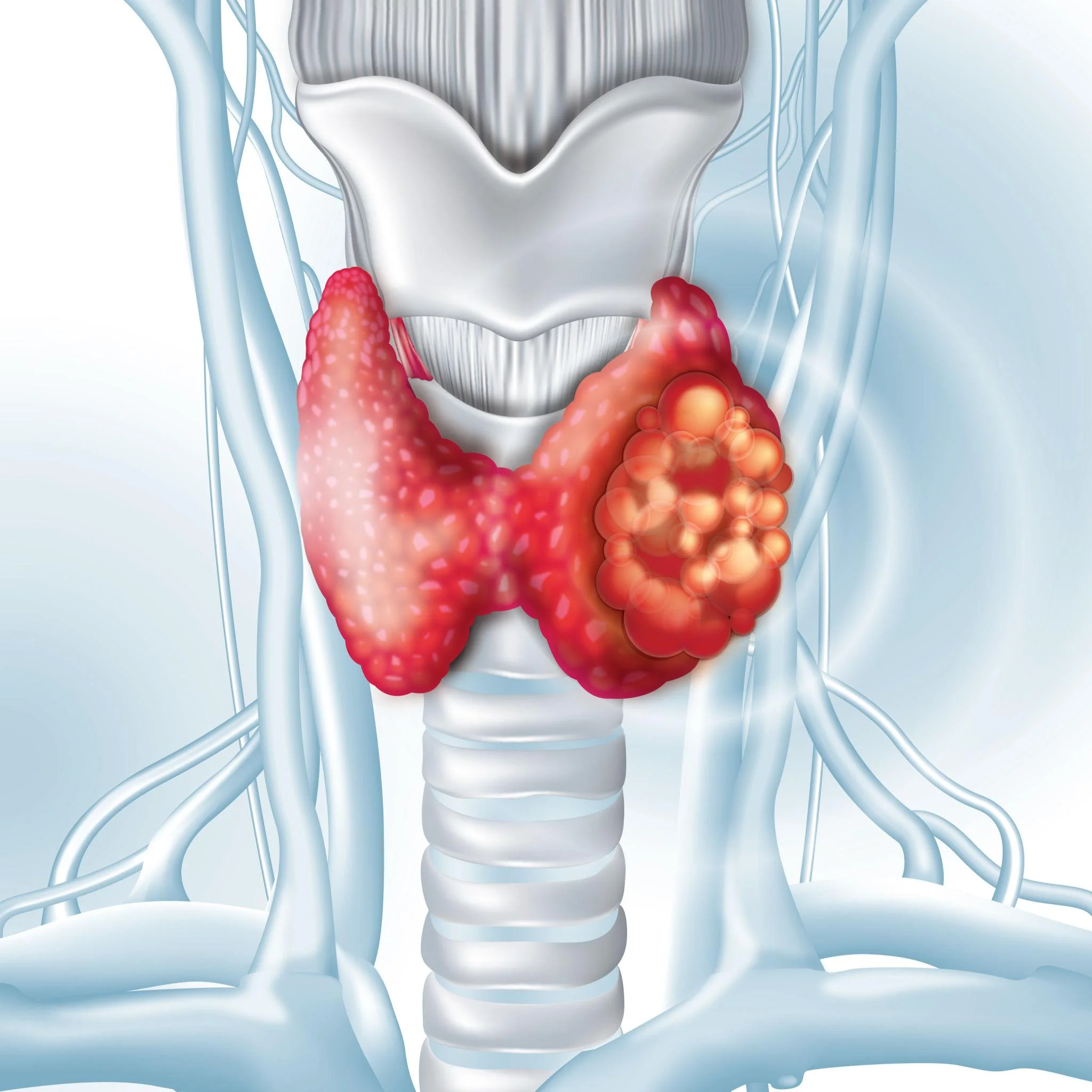 Ung thư tuyến giáp | Pharmacity
